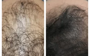 Antes y Después Alopecia con Plasma
