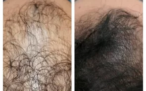 Antes y Despus Alopecia con Plasma