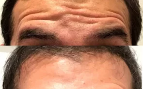 Reducción de Arrugas en Frente de Hombre