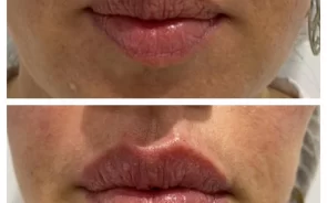 Ácido hialurónico para aumento de labios