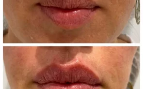 cido hialurnico para aumento de labios