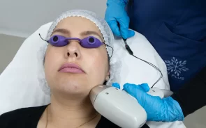 Depilacin lser en cara