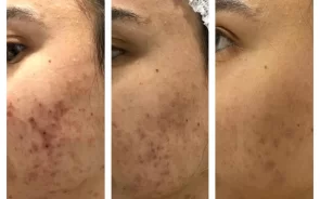 Resultados peeling facial para acné