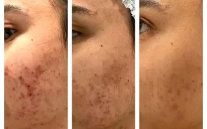 Resultados peeling facial para acn
