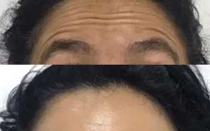 Reducción de Arrugas en la Frente