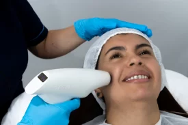 Lifting Facial con Alma Lasers