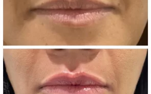 Relleno y aumento de labios
