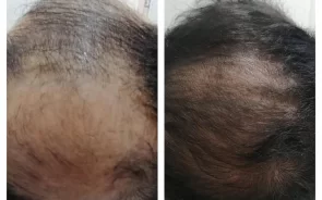 Resultados Tratamiento Alopecia
