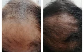 Resultados Tratamiento Alopecia