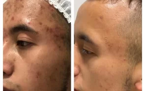 Resultados tratamiento acné nanopore