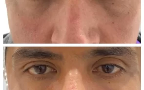 Reduccin de ojeras