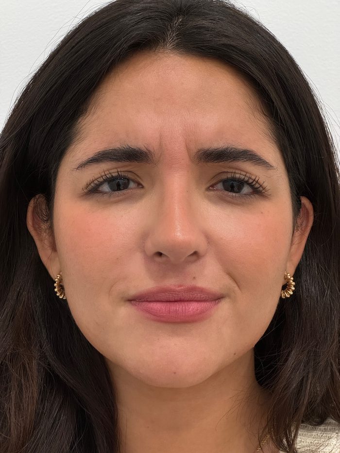 Antes del tratamiento del entrecejo con toxina