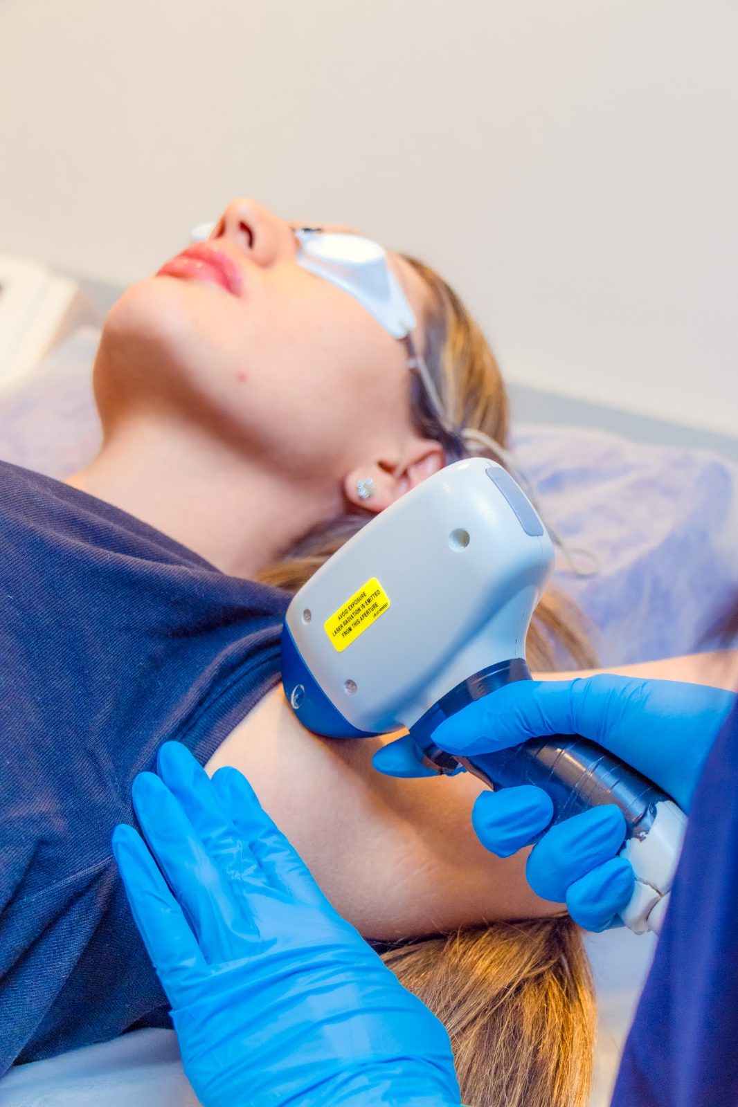 Depilación láser facial