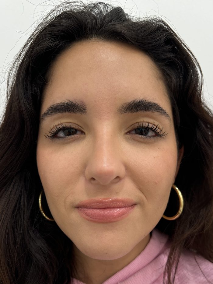 Después del tratamiento del entrecejo con toxina