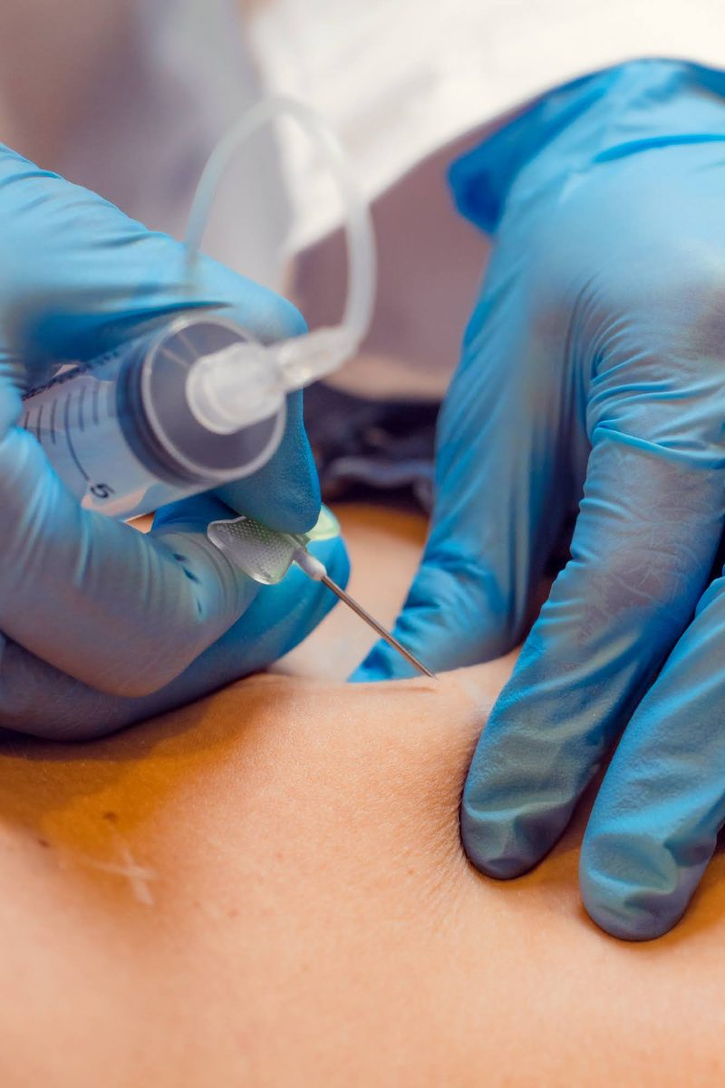 Carboxiterapia
