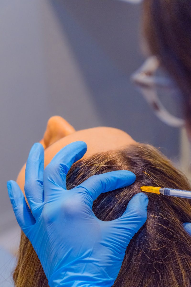 Tratamiento para alopecia