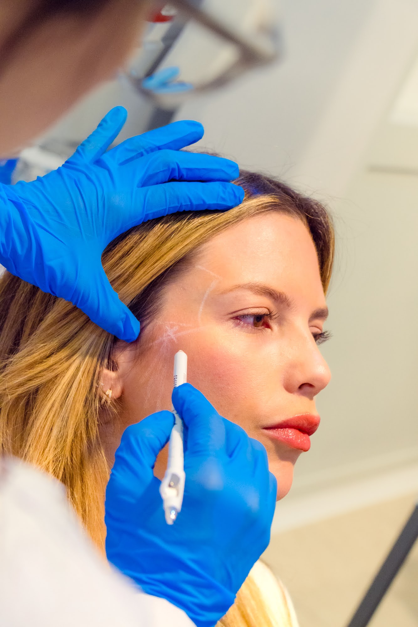 Marcación facial previa a la aplicación de Sculptra en Skin Plus Bogotá