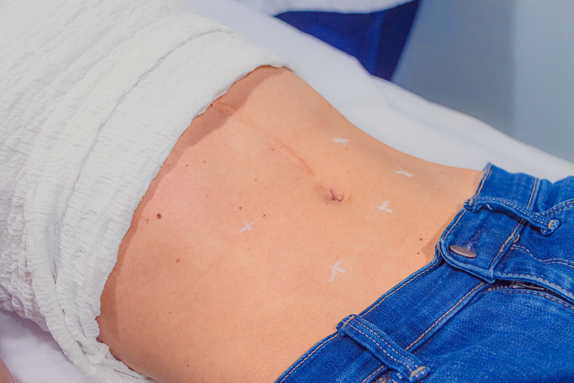 Marcación de zonas para un tratamiento corporal en Skin Plus Bogotá