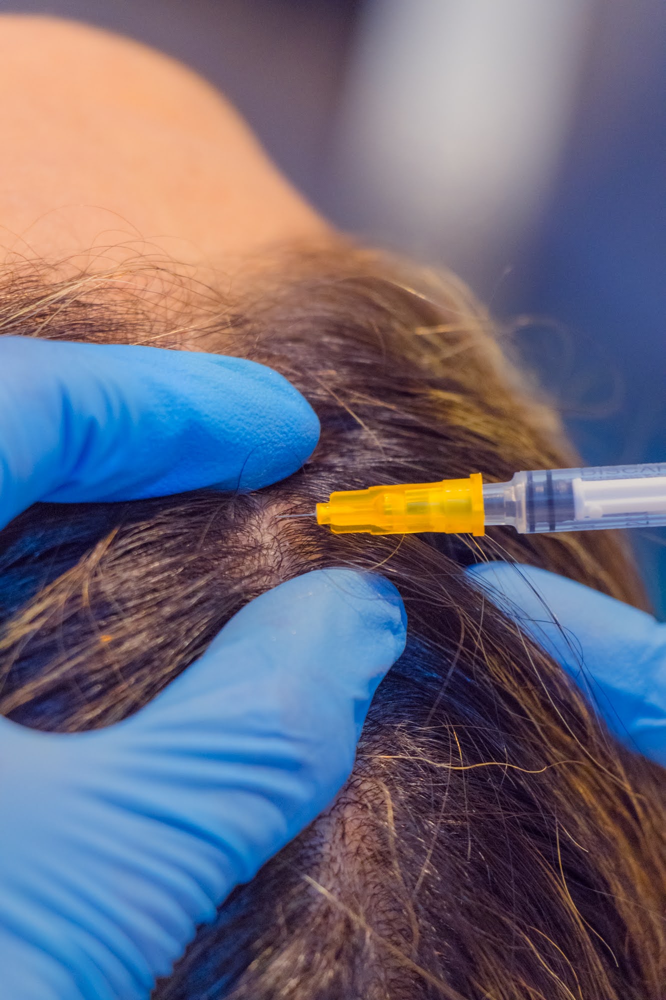 Aplicación de plasma rico en plaquetas en el cuero cabelludo en Skin Plus Bogotá