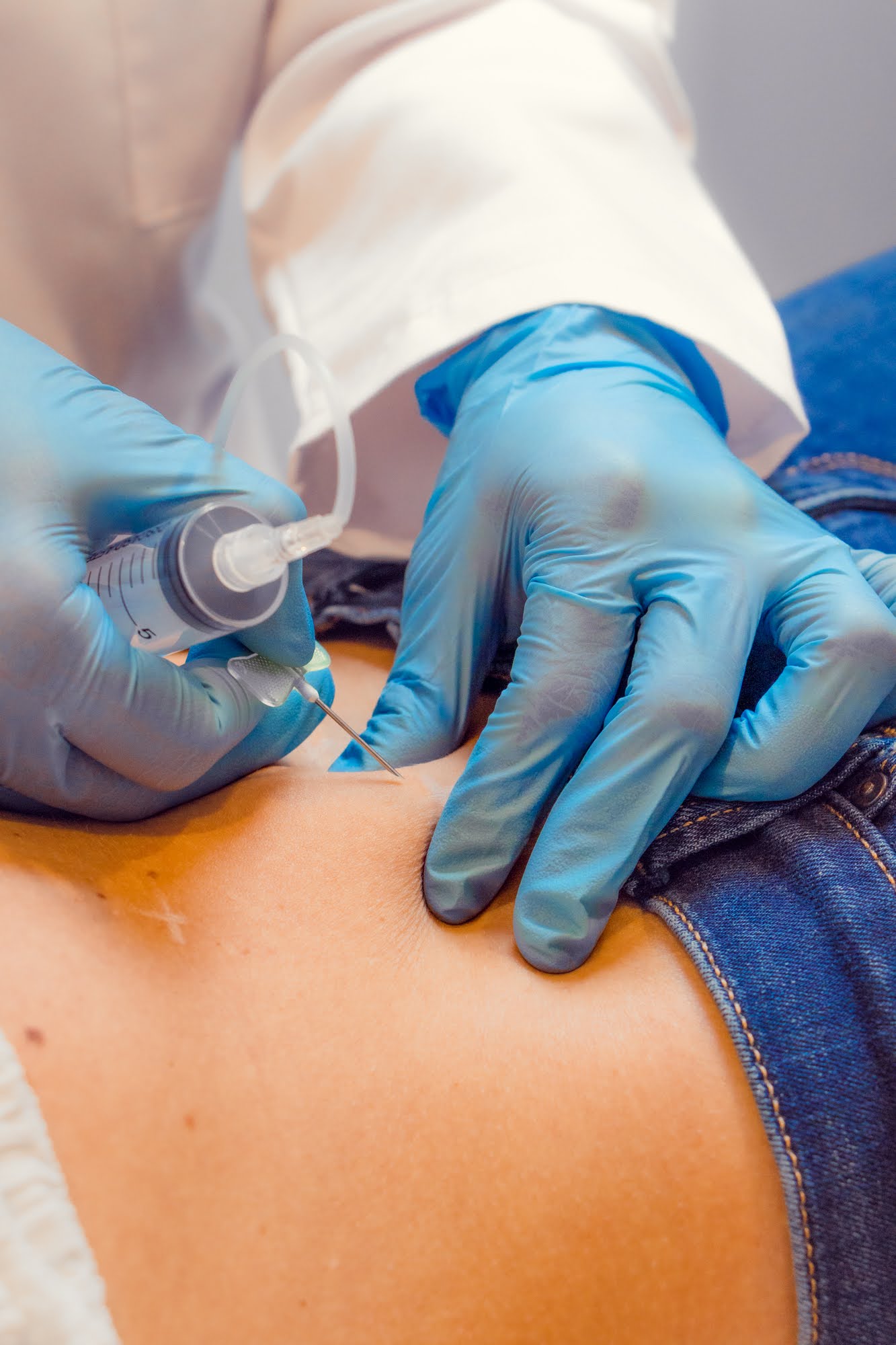 Sesión de mesoterapia corporal en Skin Plus Bogotá