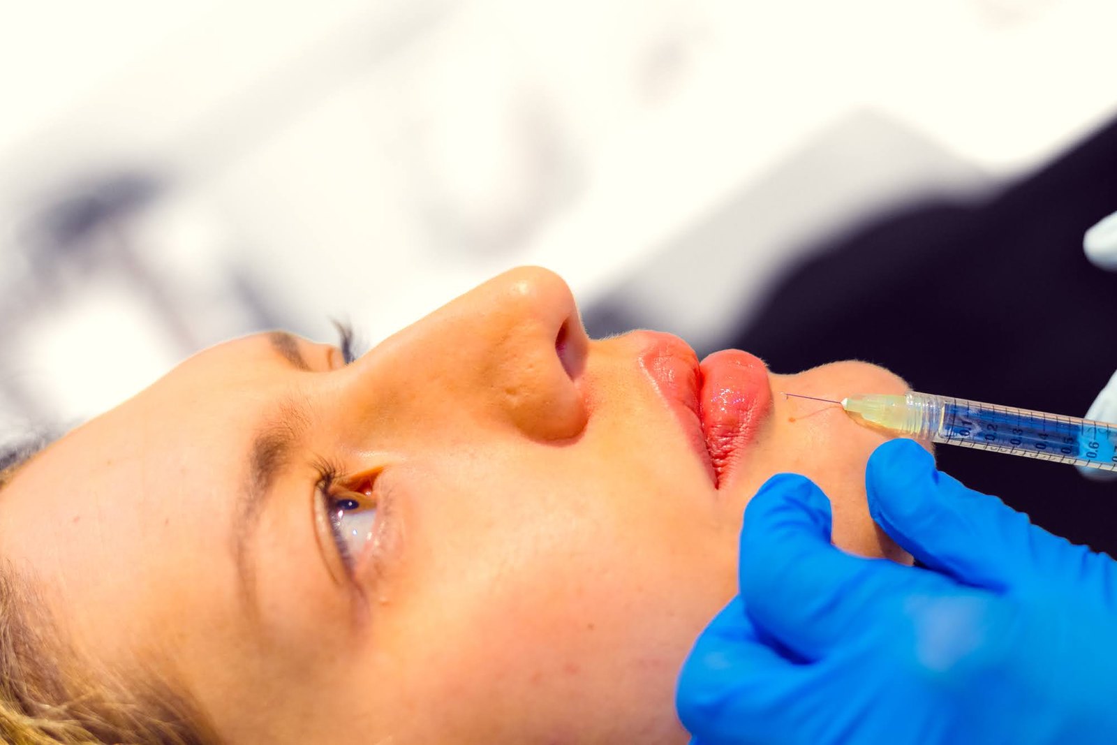 Aplicación de ácido hialurónico en Skin Plus Bogotá
