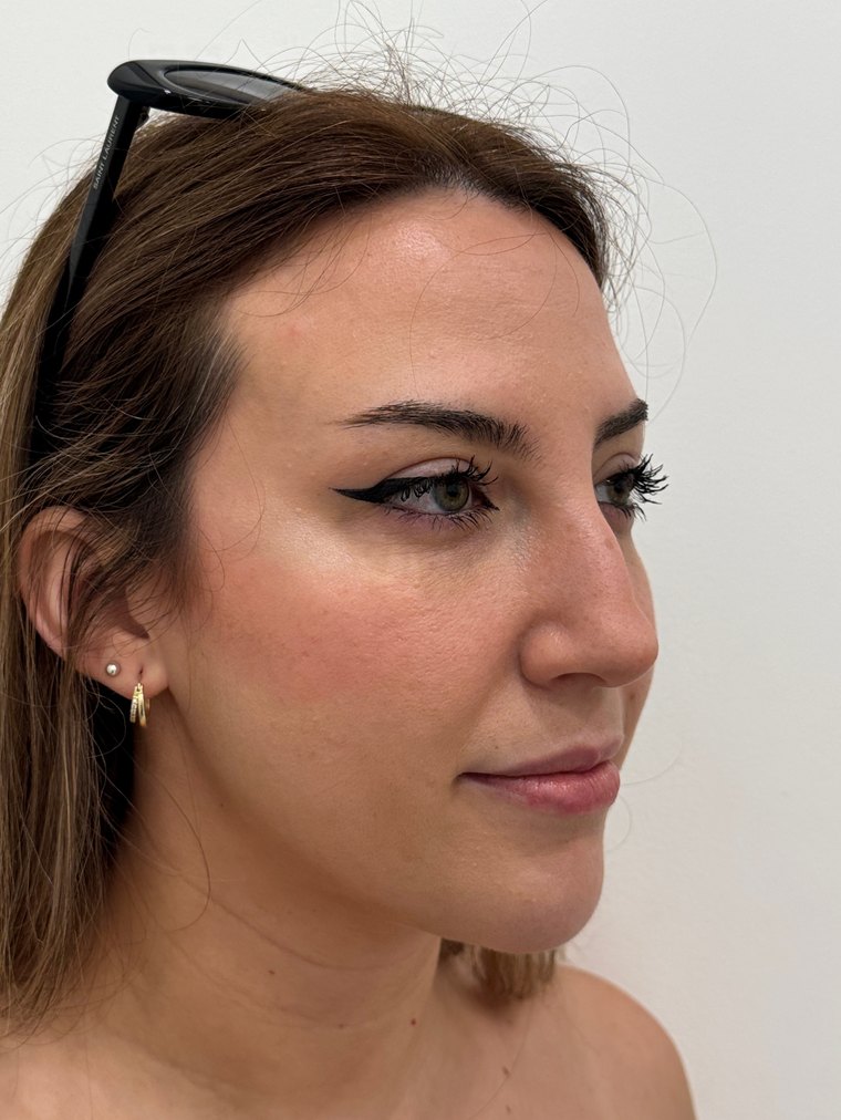 Labios antes del relleno con ácido hialurónico en Skin Plus Bogotá