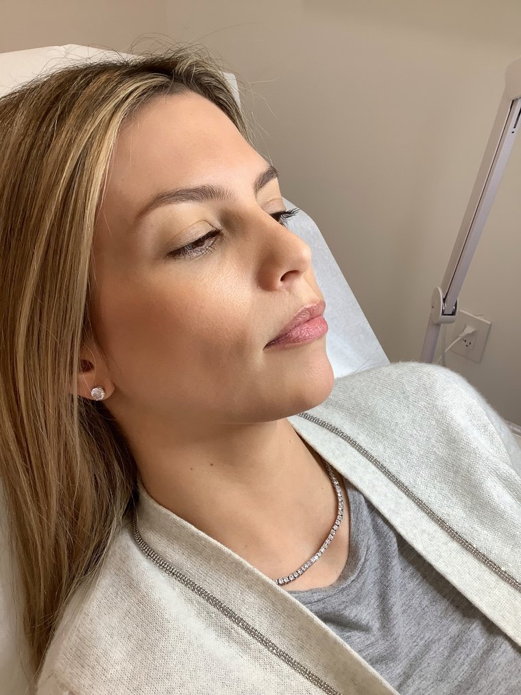 Perfilado de labios antes del ácido hialurónico