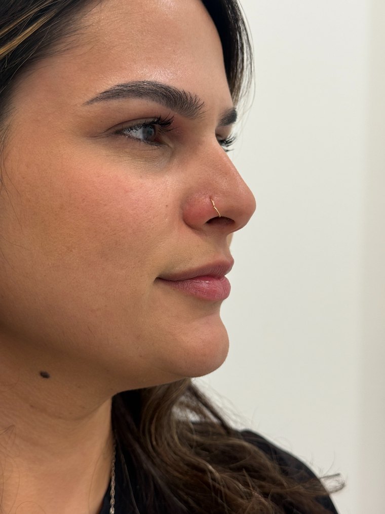 Labios antes del aumento con ácido hialurónico