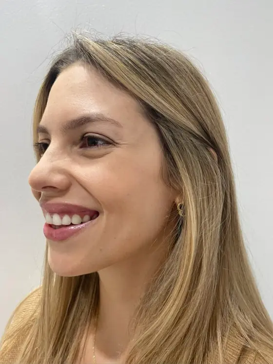 Antes de la aplicación de toxina botulínica para sonrisa gingival
