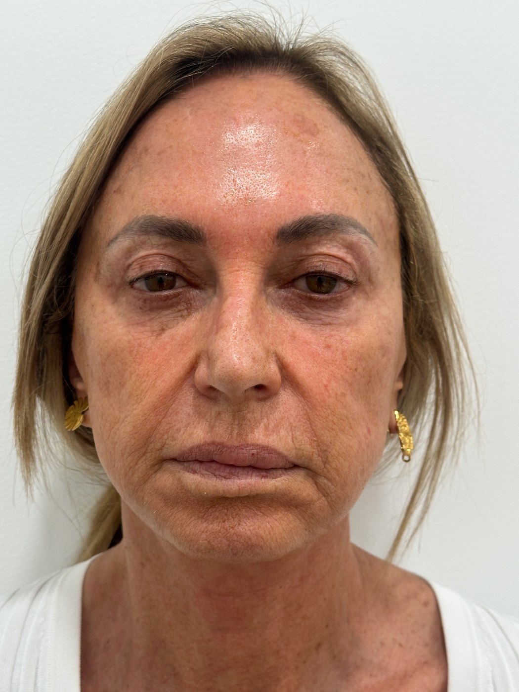 Rostro antes del tratamiento con bioestimuladores de colágeno en Bogotá