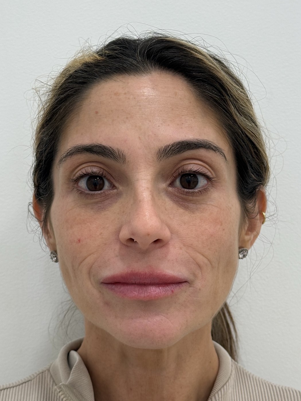 Rostro antes del tratamiento con bioestimuladores de colágeno en Bogotá