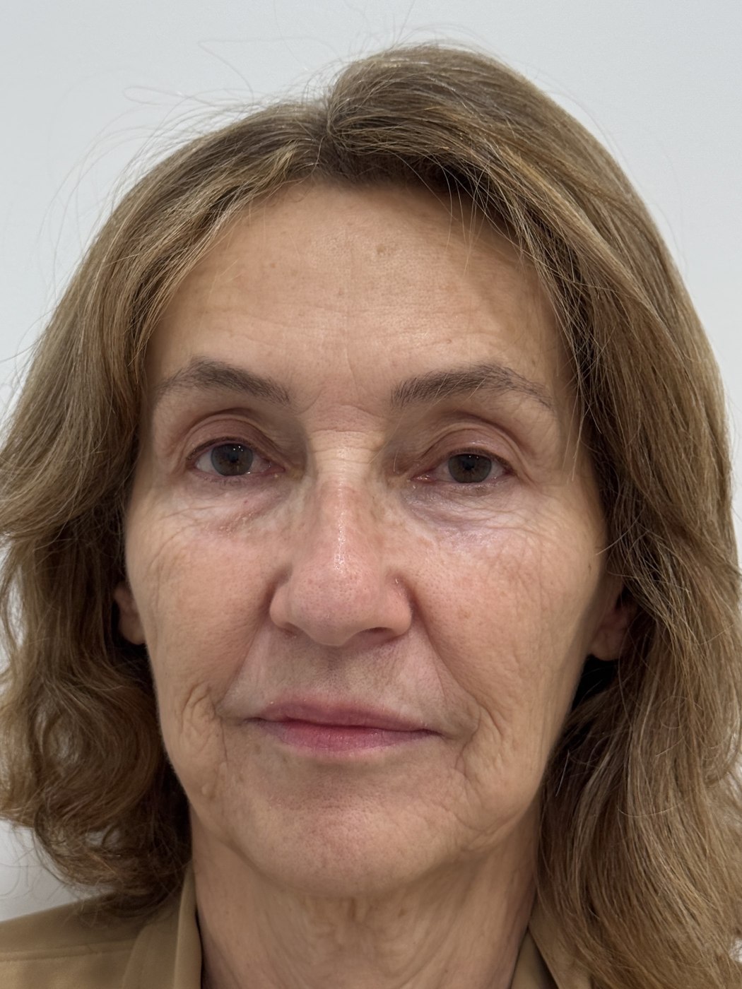 Rostro antes del tratamiento con bioestimuladores de colágeno en Bogotá