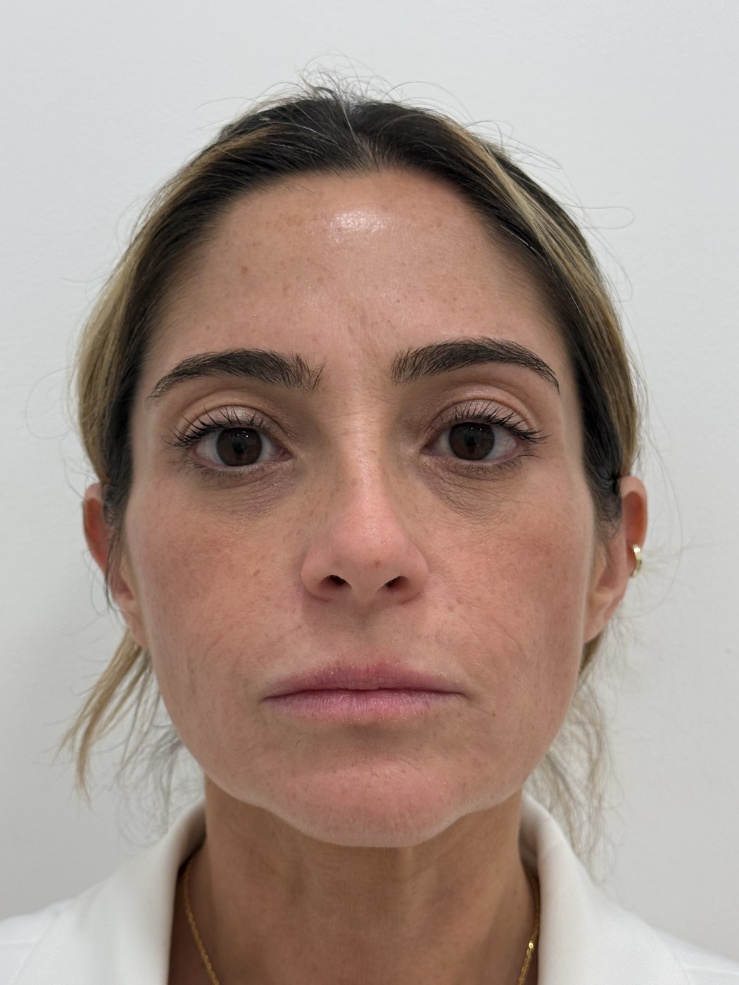 Rostro después del tratamiento con bioestimuladores de colágeno en Bogotá
