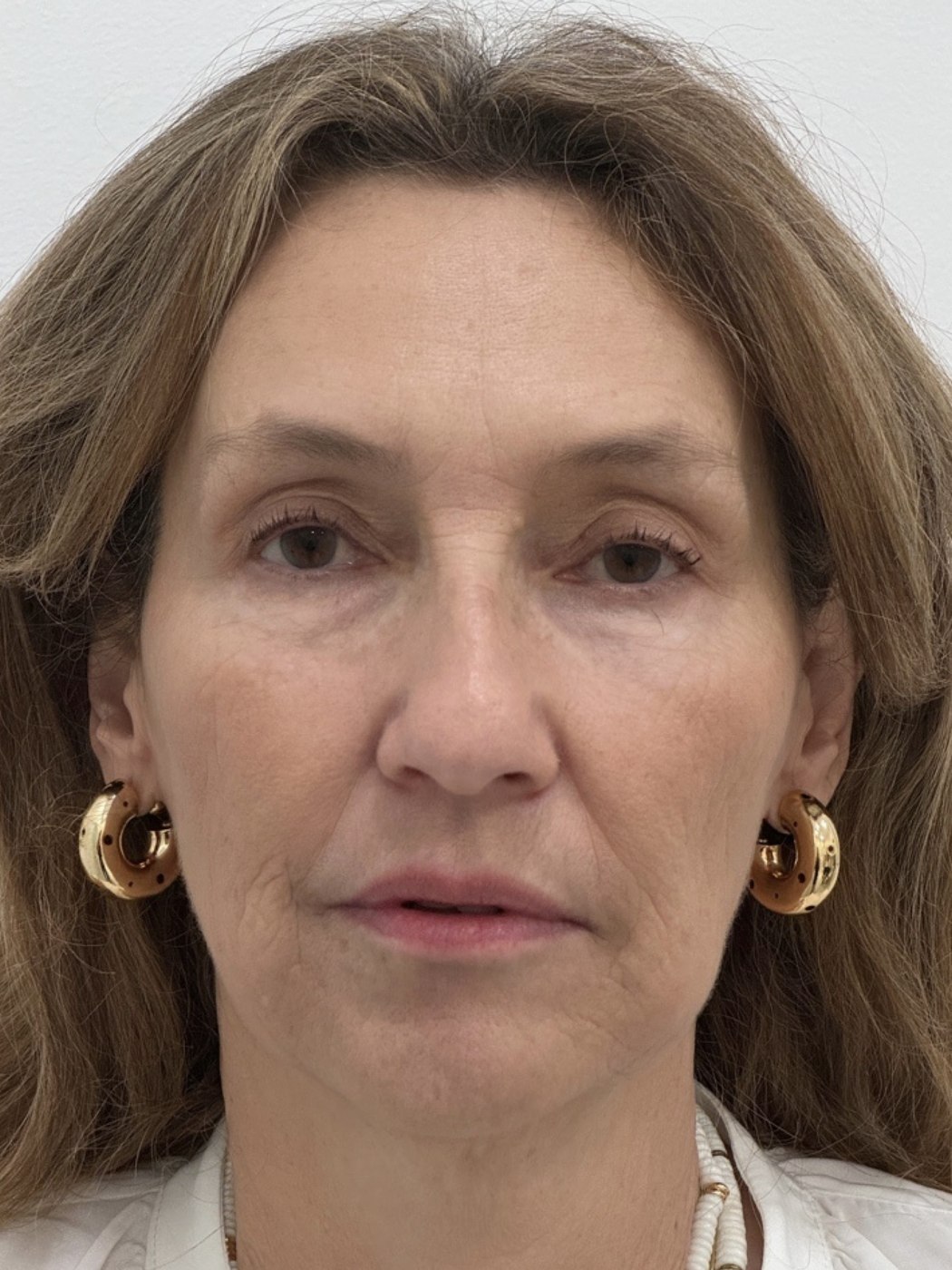 Rostro después del tratamiento con bioestimuladores de colágeno en Bogotá