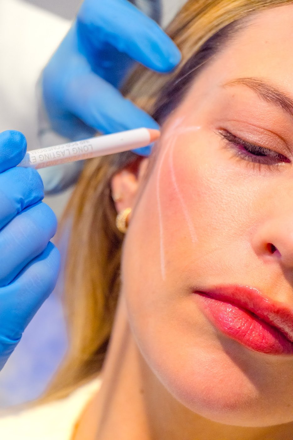 Marcación de los puntos de aplicación de bioestimuladores en el rostro