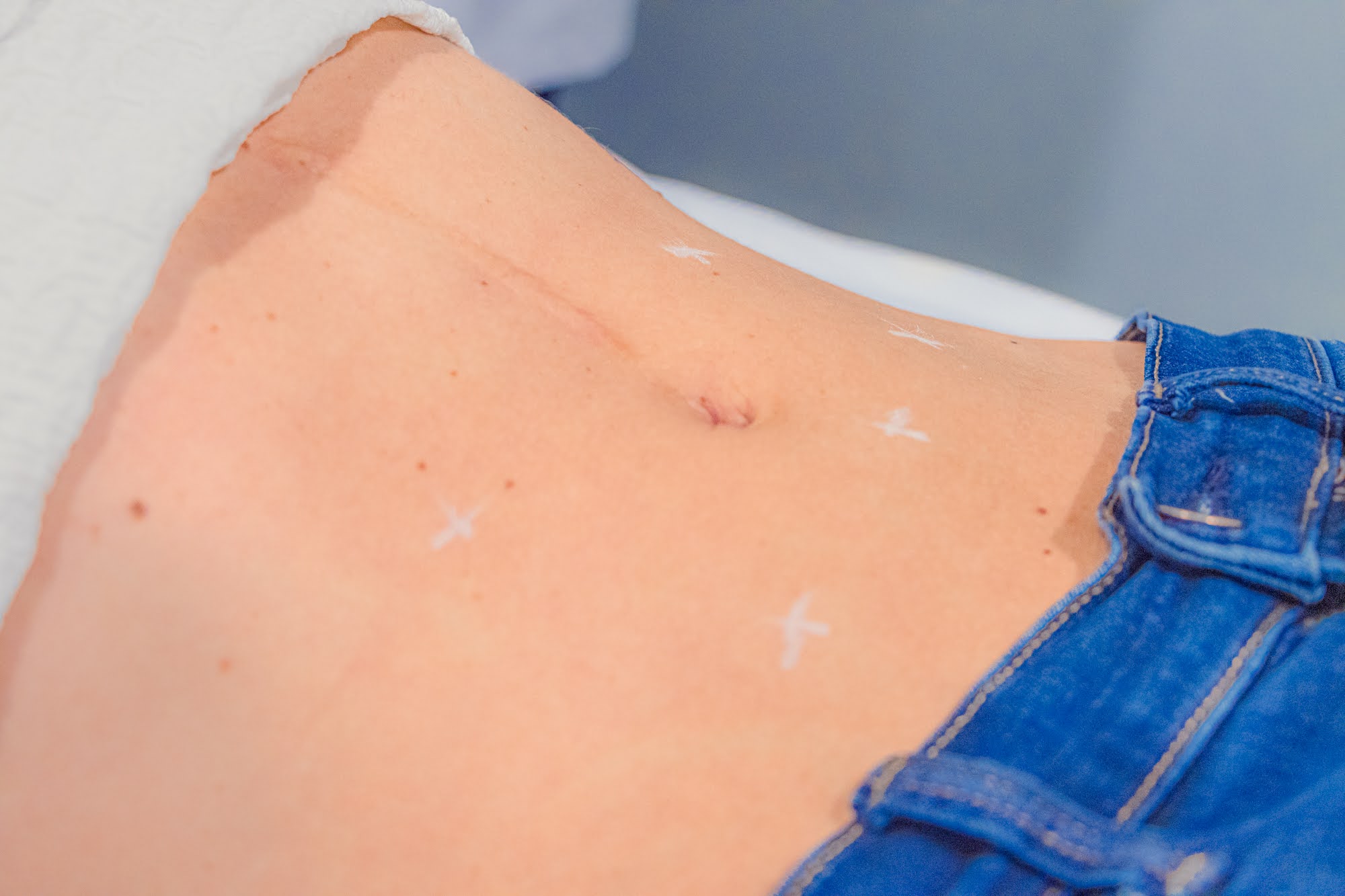 Médica de Skin Plus marcando los puntos de aplicación de mesoterapia reductora de grasa en el abdomen de una paciente