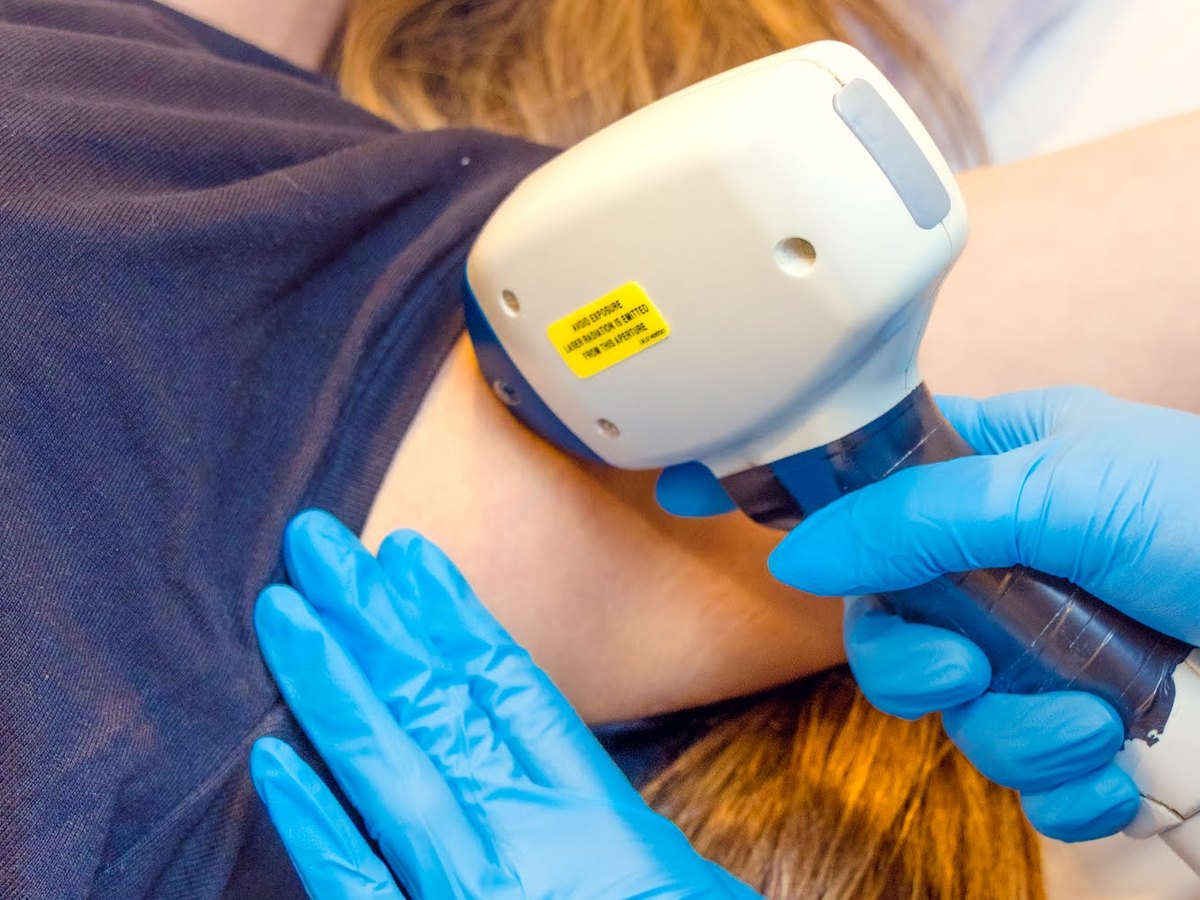 Aplicación del láser de diodo Soprano en Skin Plus Bogotá