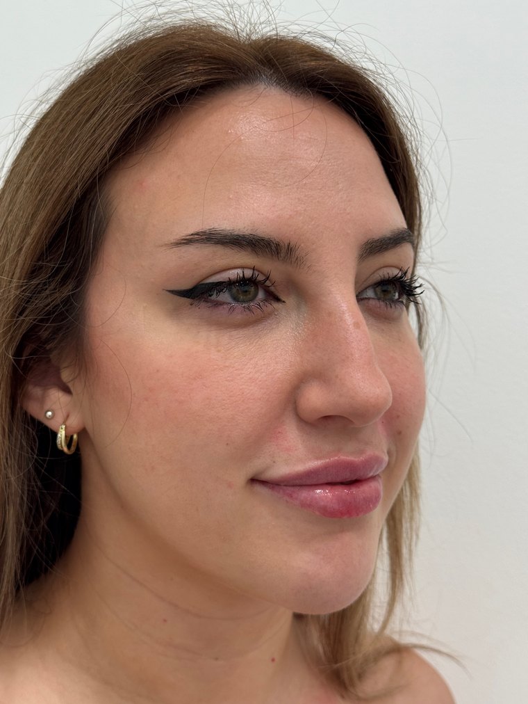 Labios después del relleno con ácido hialurónico en Skin Plus Bogotá