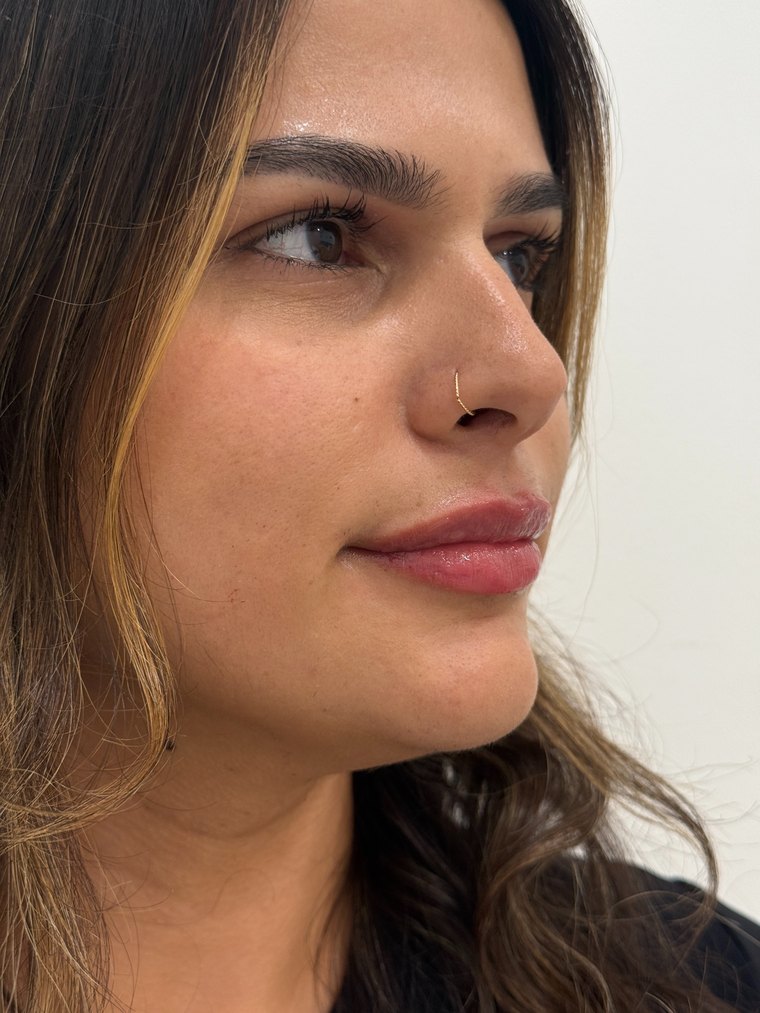 Labios después del aumento con ácido hialurónico