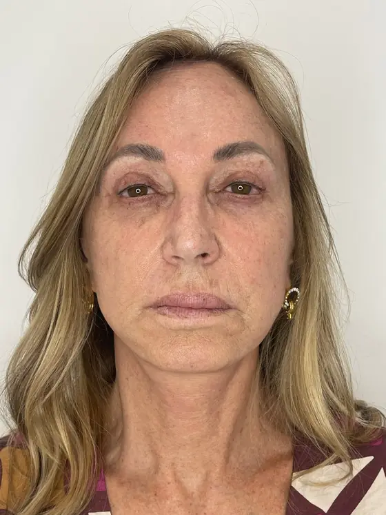 Después de la aplicación de toxina botulínica en las líneas de la frente