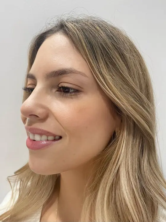 Después de la aplicación de toxina botulínica para sonrisa gingival