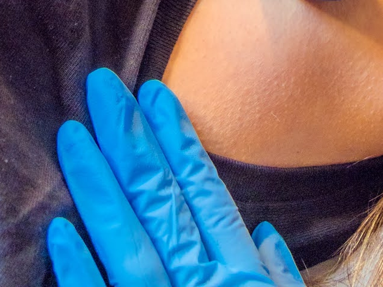 Hiperhidrosis
