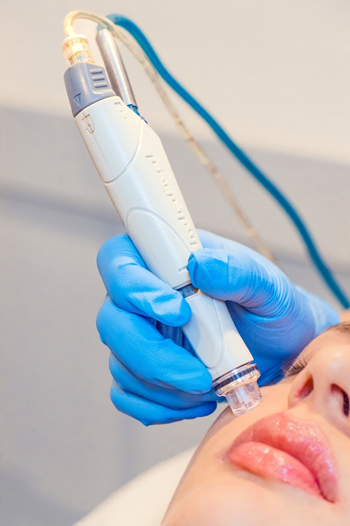 Detalle del cabezal de extracción por vacío del limpieza facial profunda en Skin Plus Bogotá